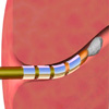 fallopian tube implant